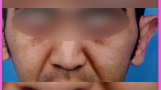 جراحی گوش برجسته یا لیفت گوش چیست ؟