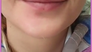 عوارض احتمالی تزریق ژل در نواحی مختلف صورت و بدن