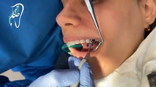 مراحل انجام کامپوزیت ونیر