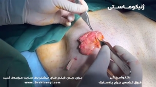 فیلم جراحی ژنیکوماستی - جراحی زیبایی سینه در مردان