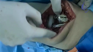 تعویض مفصل زانو