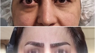 اصلاح بیرون‌زدگی چشم