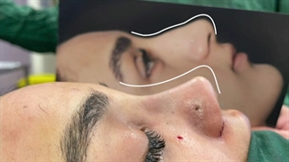 نتیجه جراحی زیبایی بینی در اتاق عمل