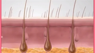 آیا لیزر بیکینی برای دختران عوارض دارد؟ شایعه نازایی و سرطان