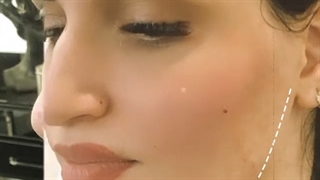 فرم دهی و زاویه سازی صورت با تزریق چربی