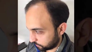نمونه ایی دیگر از کاشت مو در تهران