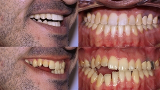 ارتودنسی ناهنجاری اپن بایت | دکتر داودیان