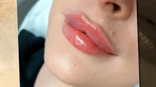 تزریق ژل لب به روش روسی