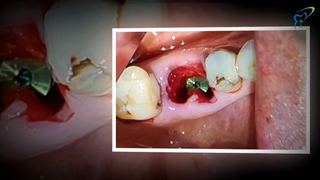 ویدئو واقعی ایمپلنت دندان ببینید