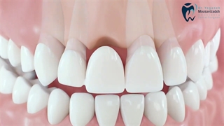 روش های جایگزین دندان (ایمپلنت دندان)