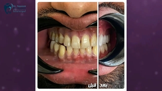 اصلاح طرح لبخند