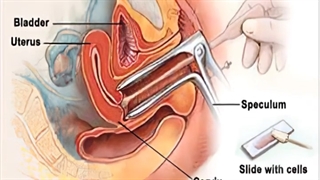 شروط انجام تست پاپ اسمیر