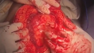 خارج سازی تومور لیپوسارکوم ناحیه لگن