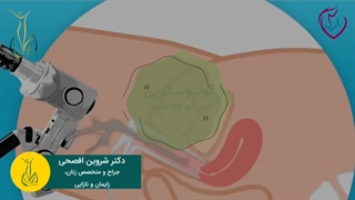 کولپوسکوپی چرا و چگونه؟