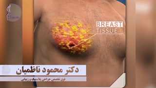 راه حل بزرگی سینه در آقایان‼️