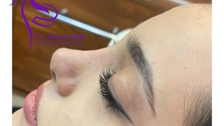 جراحی بینی یک ماه پس از عمل