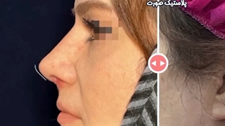 نمونه کار جراحی زیبایی بینی | دکتر شاهرخ خوش سیرت
