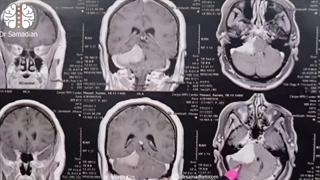 عمل جراحی مننژیوم پتروکلایوال با گسترش به CPA