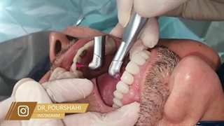 جداکردن بریج بدون تراشیدن و احتمال اسیب | کلینیک دندانپزشکی دکتر پورشاهی