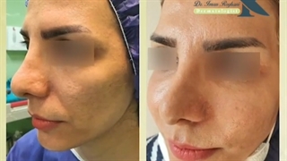 تزریق چربی جهت جوانسازی و ریمودلنیگ صورت