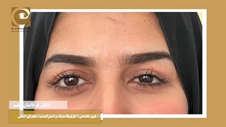 بلفاروپلاستی دو پلک بالا همراه با ترمیم افتادگی غده های اشکی دوطرف