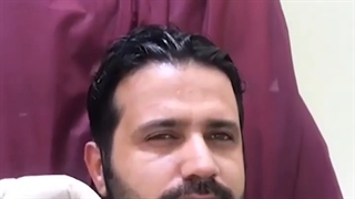 برداشتن خال روی صورت