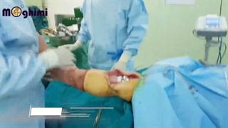 عمل رویژن توتال نی آرتروپلاستی یا تعویض مجدد مفصل زانو