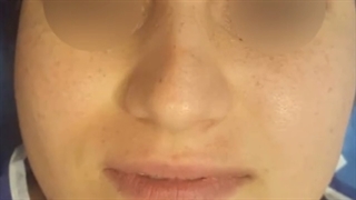 فیلم عمل جراحی بینی در اتاق عمل