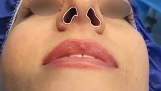 فیلم جراحی زیبایی بینی