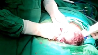 فیلم سزارین اورژانسی