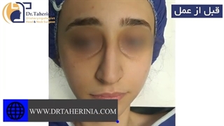 جراحی بینی استخوانی قوزدار