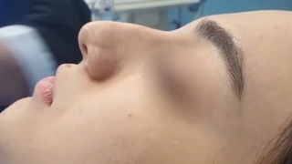 نتیجه جراحی زیبایی بینی