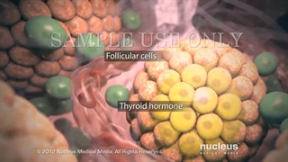 سرطلن تیروئید | ضروری‌ترین مواردی که در رابطه با سرطان تیروئید باید بدانید