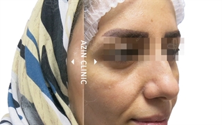 تزریق چربی صورت و جوانسازی