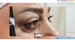 فیلم واقعی و بدون سانسور از عمل بلفاروپلاستی پلک بالا