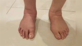 صافی کف پای بزرگسالان اکتسابی