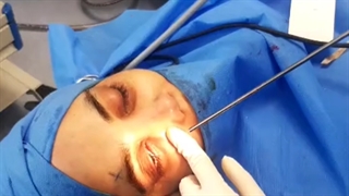 فیلم بدون سانسور جراحی آندوسکوپیک و بدون بخیه مجرای اشکی
