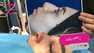 فیلم جراحی بینی در اتاق عمل