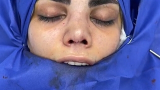 فیلم واقعی و بدون سانسور جراحی بینی در اتاق عمل از نزدیک