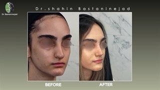 قبل و بعد جراحی بینی طبیعی | دکتر باستانی نژاد