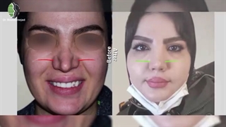 هشت ماه پس از عمل ترمیم بینی با غضروف دنده | دکتر باستانی نژاد