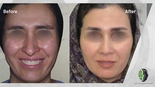 جراحی رینوپلاستی