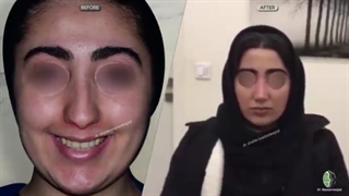 جراحی زیبایی بینی | دکتر باستانی نژاد