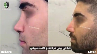 جراحی ترمیمی بینی کاملا طبیعی و مردانه | دکتر باستانی نژاد