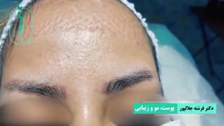 کاشت ابروی طبیعی قابل رنگ کردن و اصلاح | دکتر فرشته جلالپور