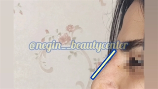 تزریق فیلر و ژل بینی در نگین گرگان 09336093000 کربوکسی تراپی