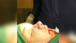 جراحی بینی در گرگان گنبد - فوق تخصص زیبایی ۰۹۳۳۶۰۹۳۰۰۰