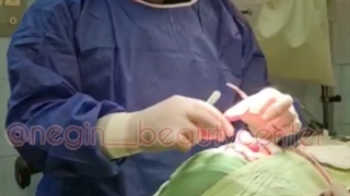 جراحی بینی ترمیمی و مشکل در گرگان توسط فوق تخصص زیبایی 09336093000