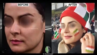 جراحی زیبایی بینی بزرگ با سوراخ های بزرگ | دکتر باستانی نژاد