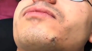 جراحی برداشتن خال صورت